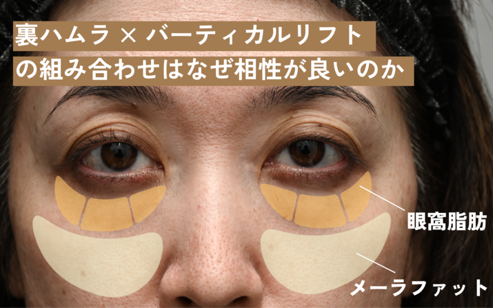 【裏ハムラ×バーティカルリフト】同時治療で最高の相乗効果をもたらす若返り教えます