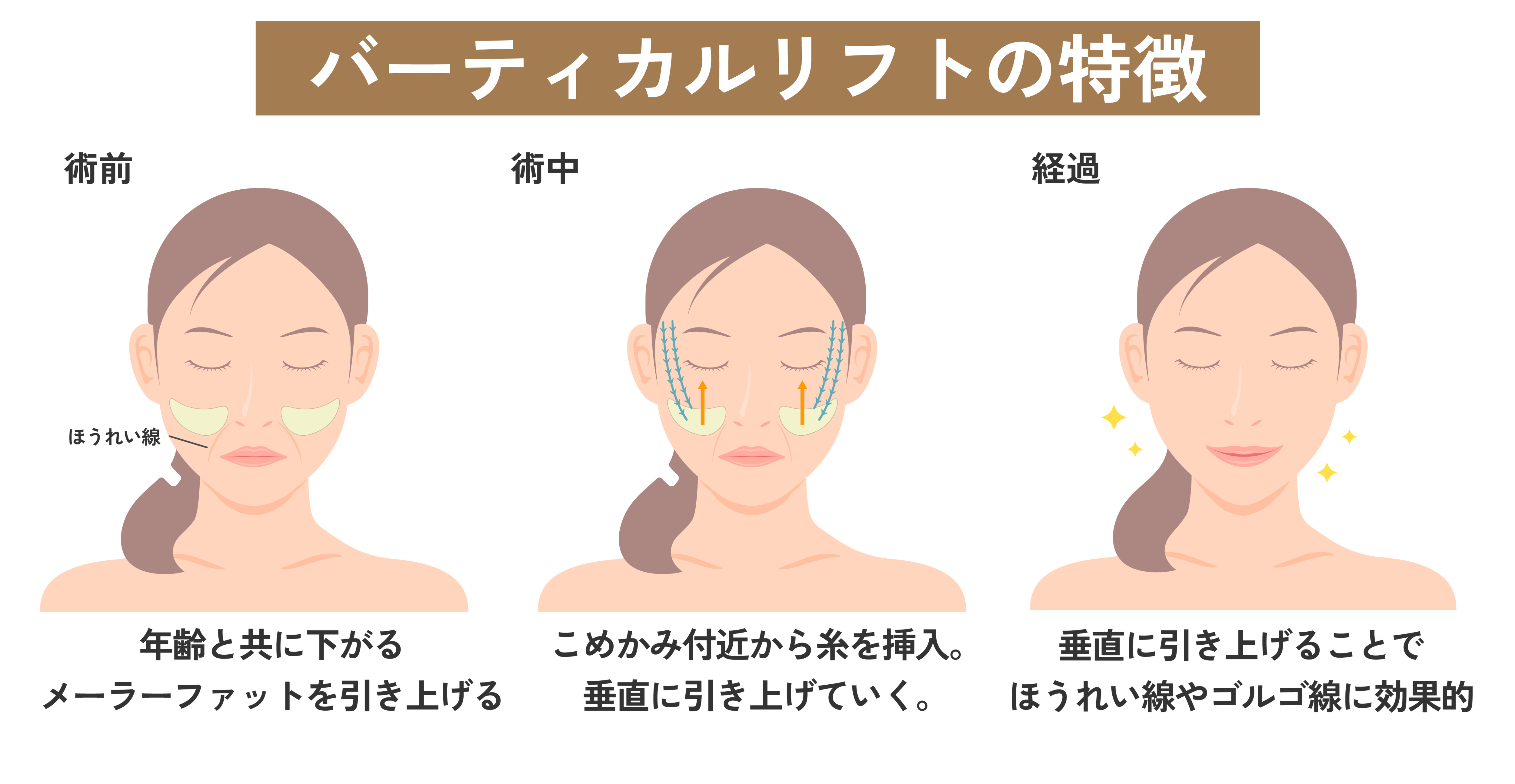 真上に引き上げる中顔面リフト治療/バーティカルリフト