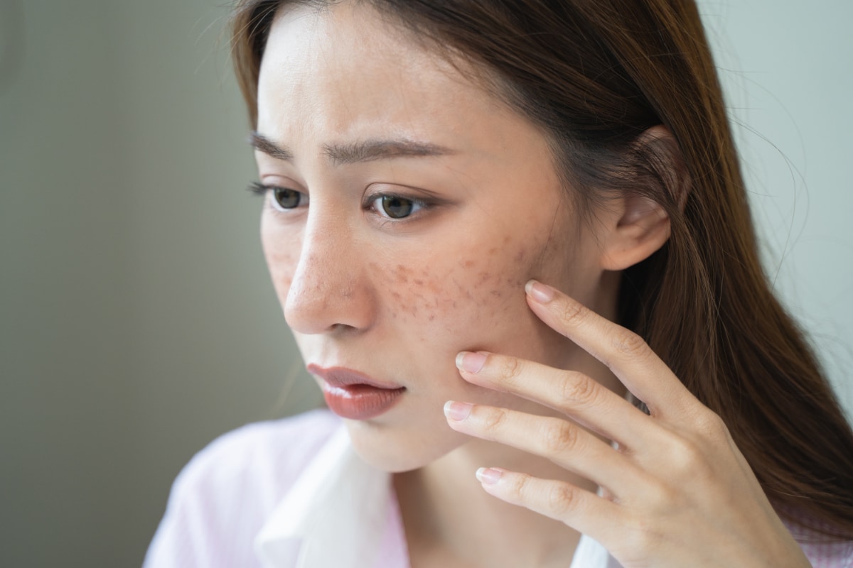 シミ・くすみ、色ムラ、肝斑が気になる方の強い味方