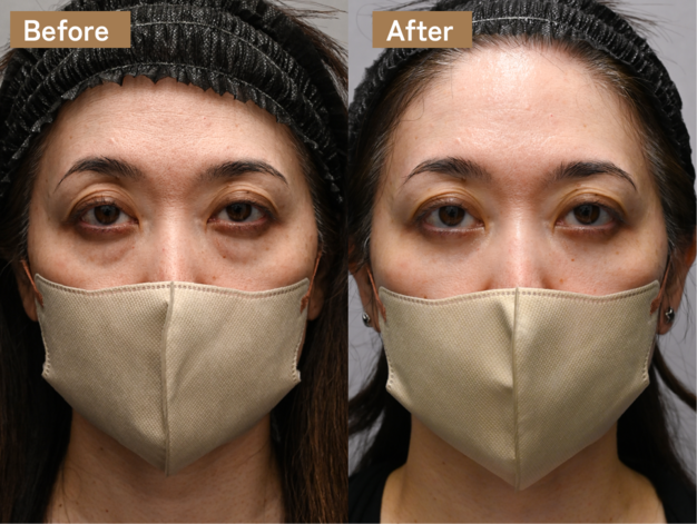 同時施術で“目元＋中顔面”を一体で若返らせる考え方