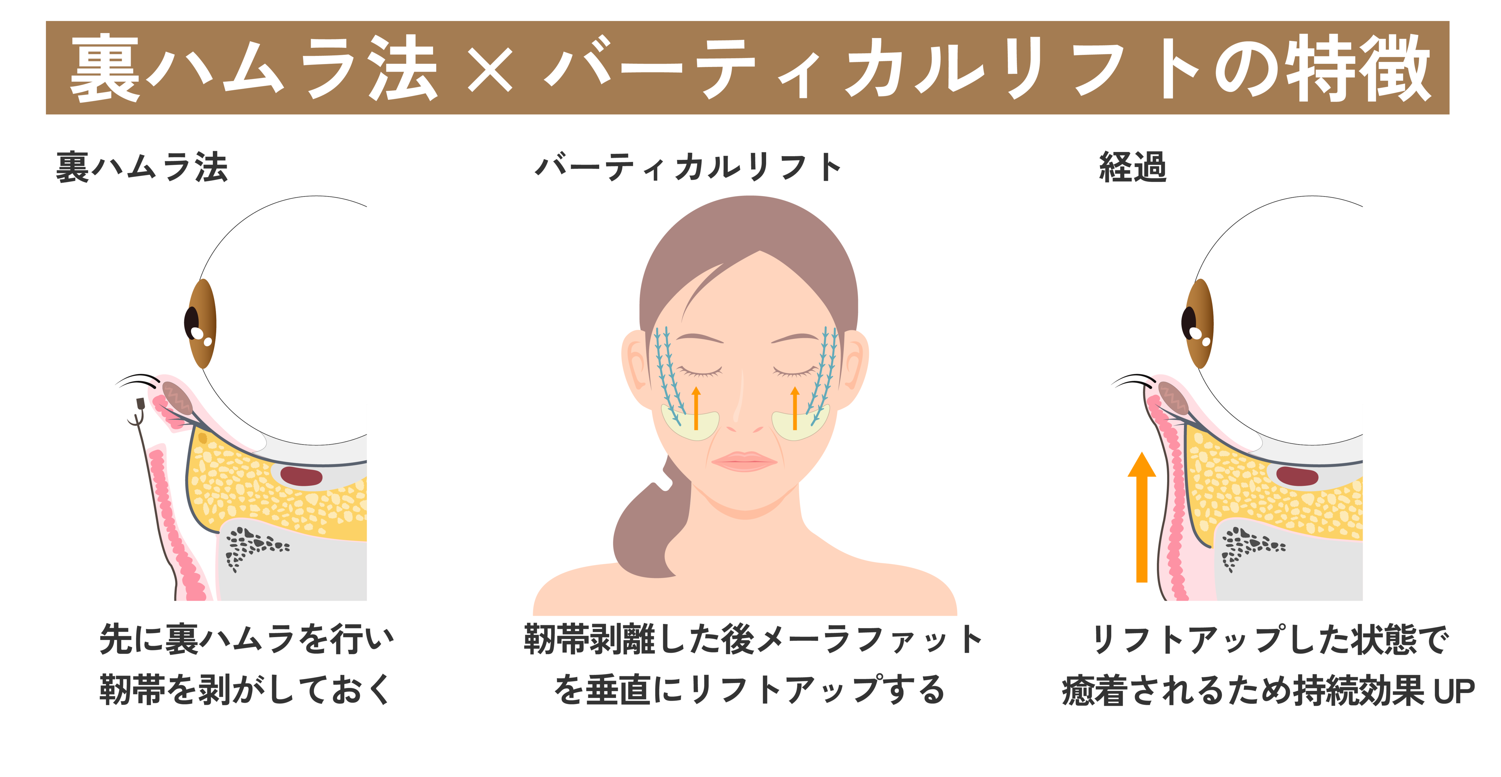 引き上げた位置で靭帯が自然に癒着するから