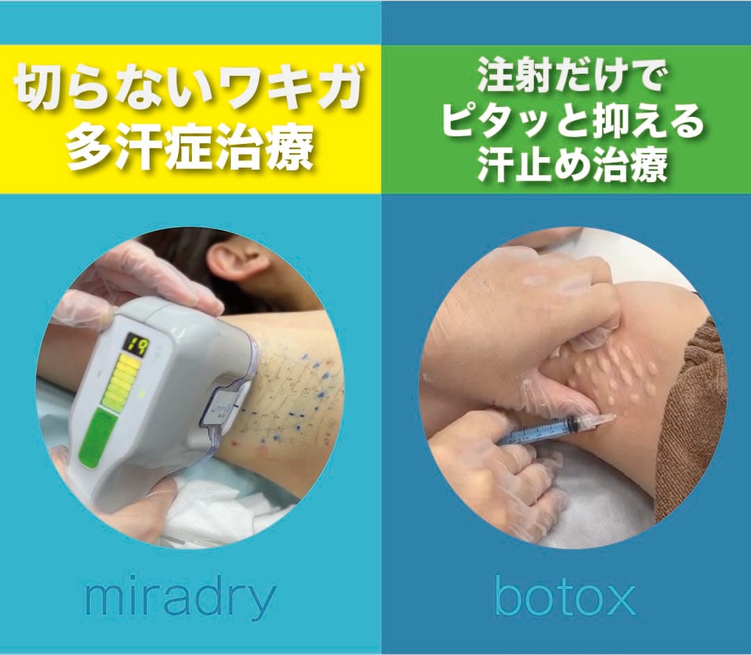 miradry_botox