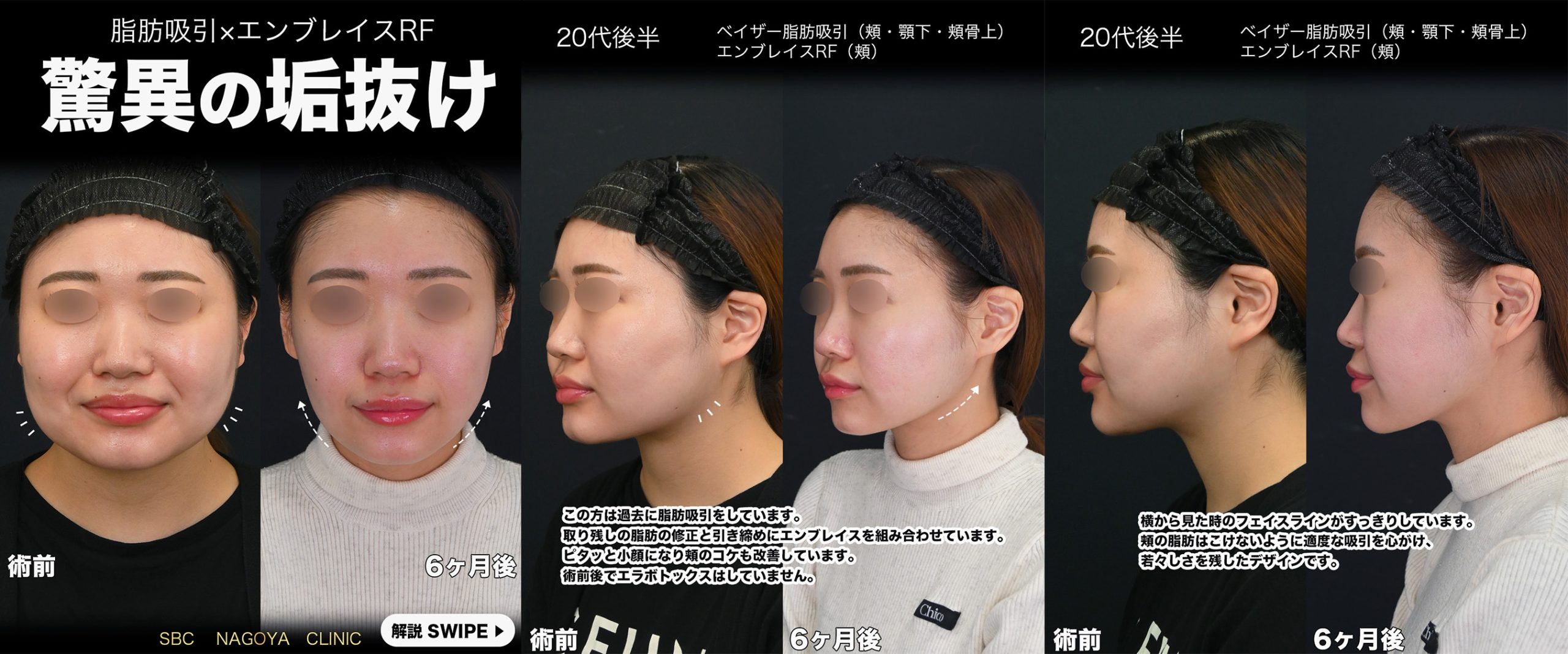 山本高士医師執刀：顔の脂肪吸引の症例写真