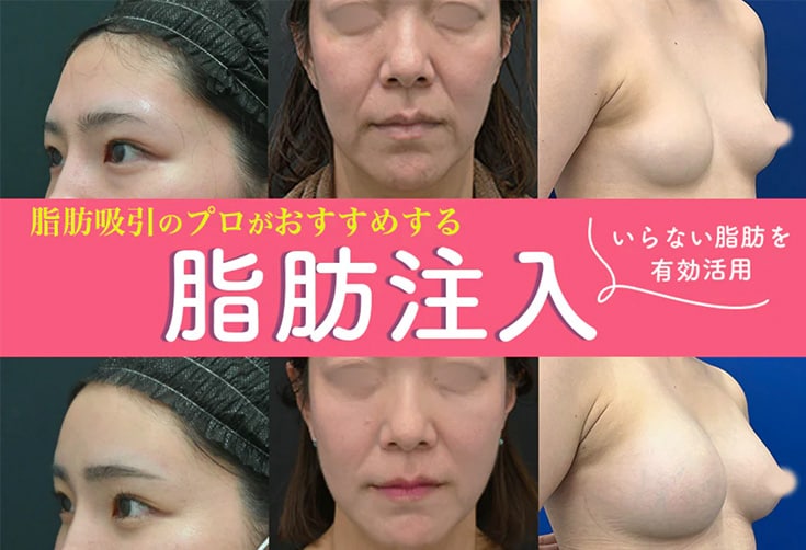名古屋・栄で脂肪注入するなら【脂肪のプロ】脂肪吸引の名医山本高士医師がおすすめ！