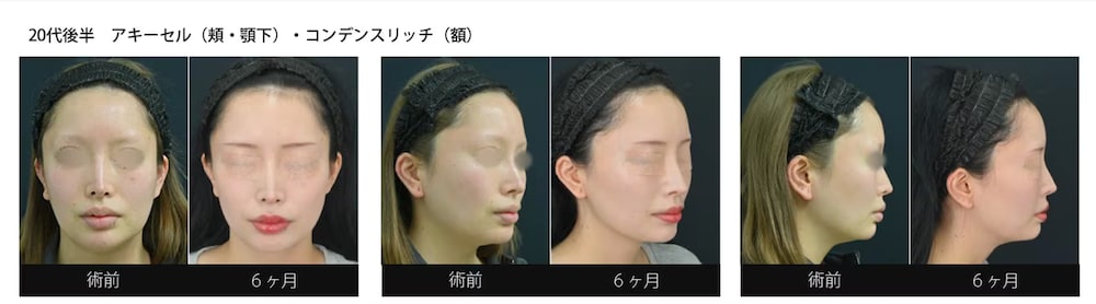 太ももから脂肪をとっておでこに移動！