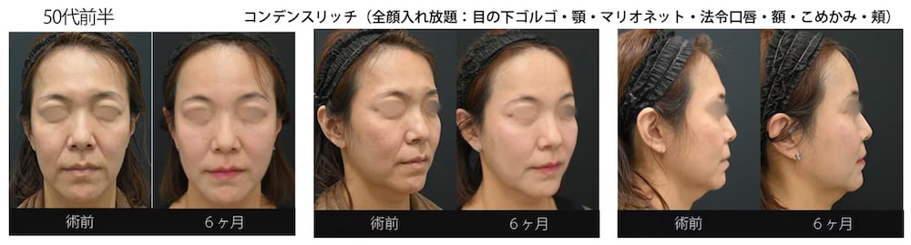 顔の脂肪注入し放題！