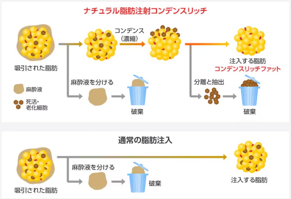 ナチュラル脂肪注射コンデンスリッチ（脂肪注入）とは？