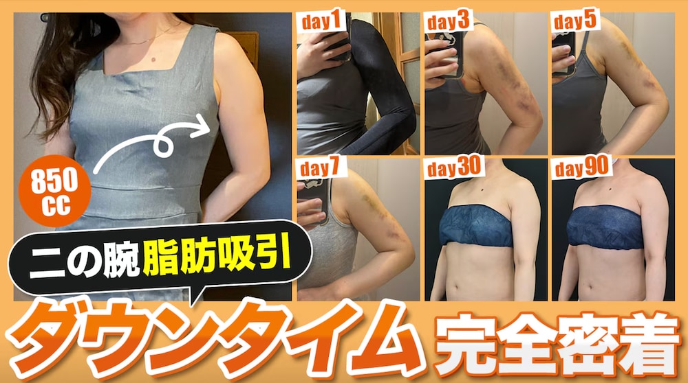 【完全密着】生活に支障ある？二の腕の脂肪吸引のダウンタイムの全て　【湘南美容クリニック 名古屋栄院】