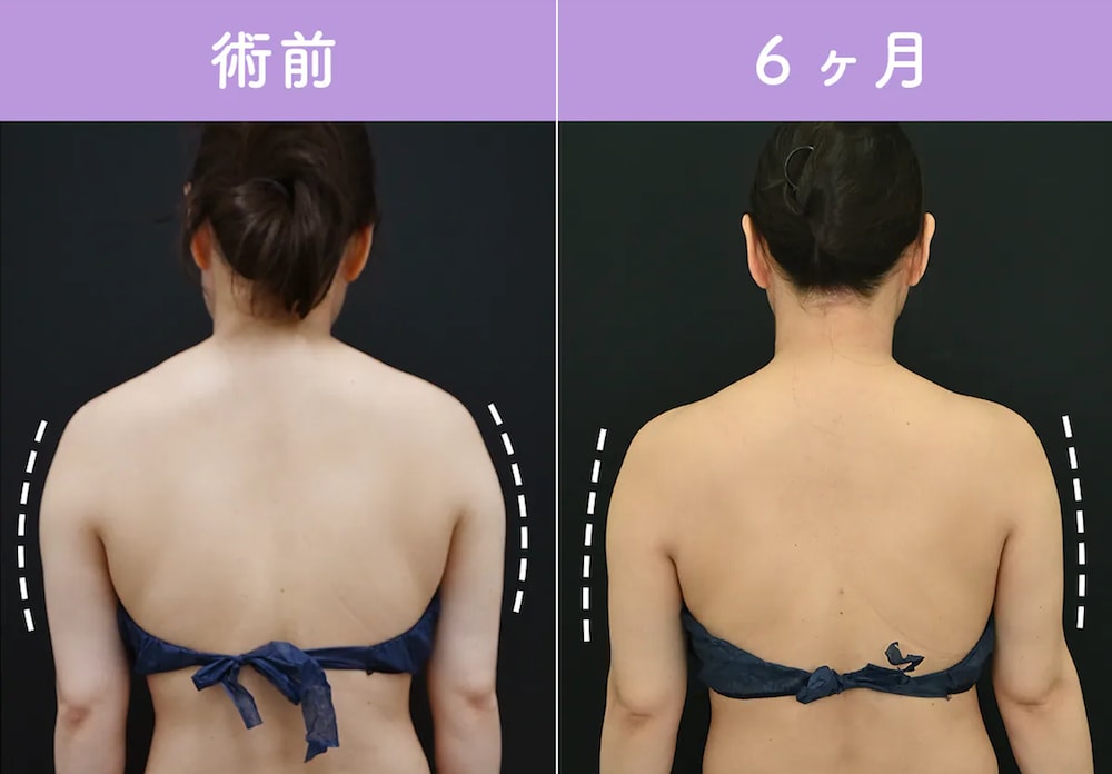 ベイザー脂肪吸引（上腕＋肩＋肩甲骨横上＋背中＋胸上部）エンブレイスRF（二の腕）
