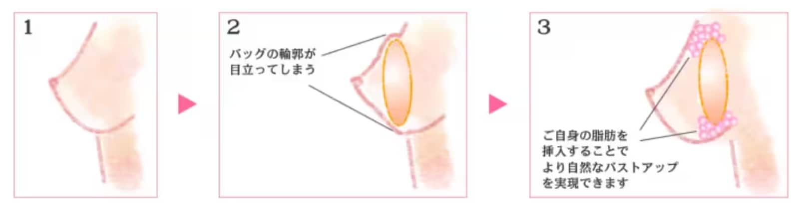 ハイブリッド豊胸