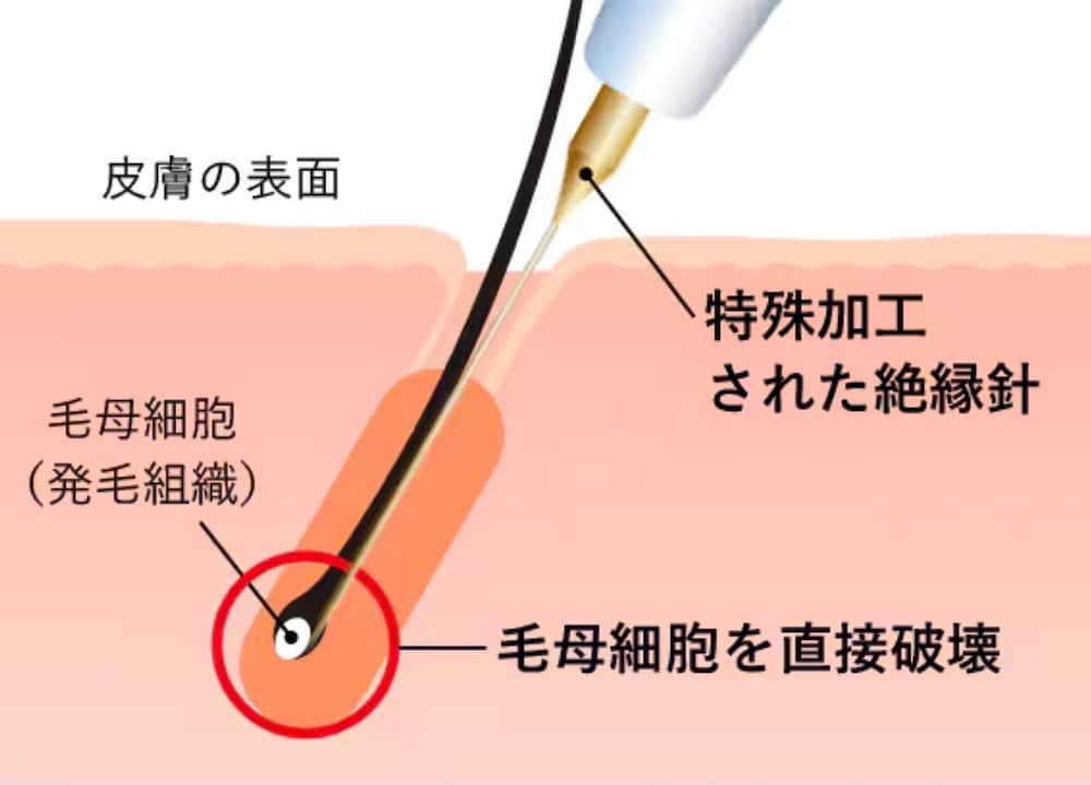 ニードル脱毛って何？
