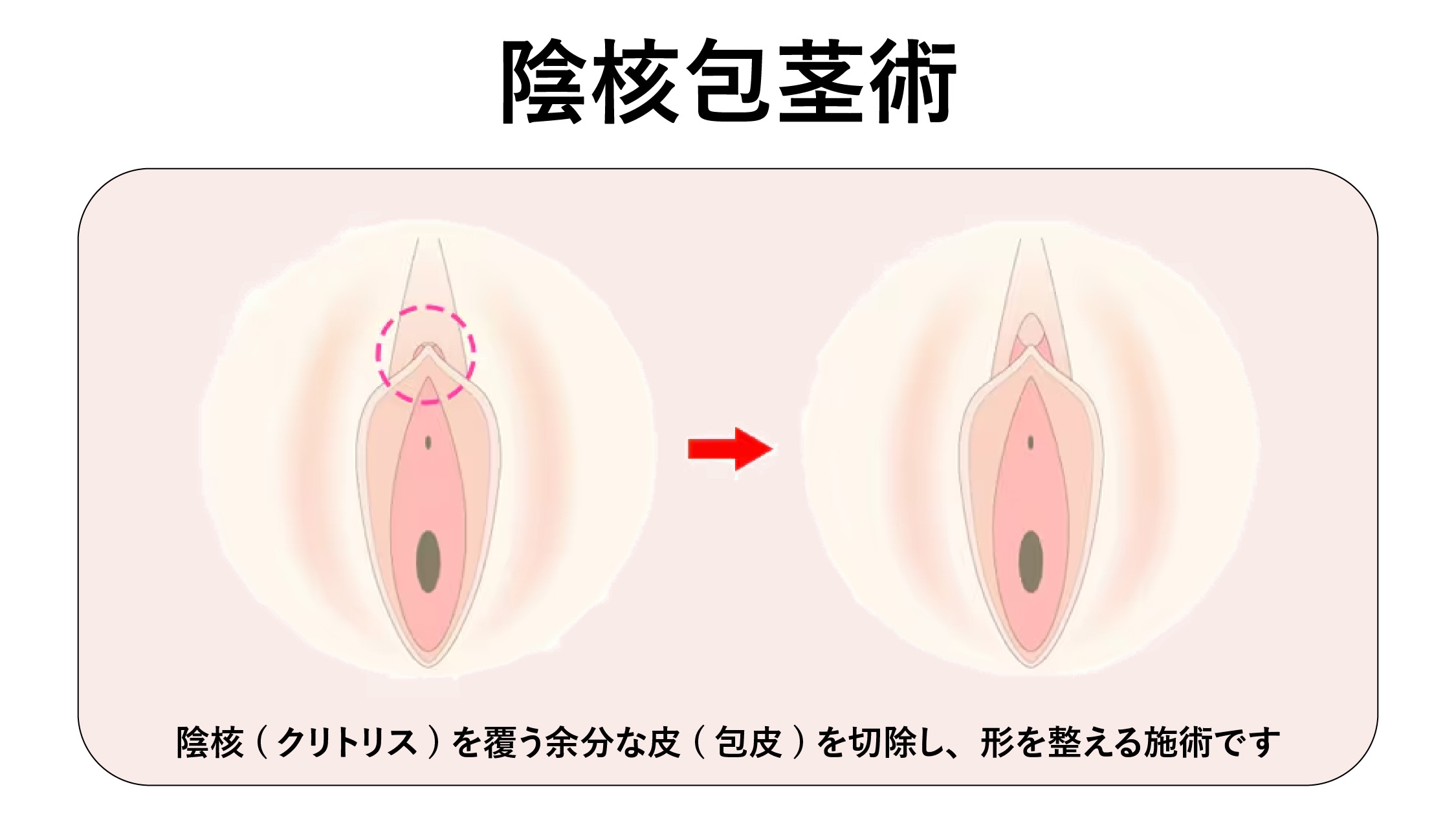 陰核（クリトリス）包茎術