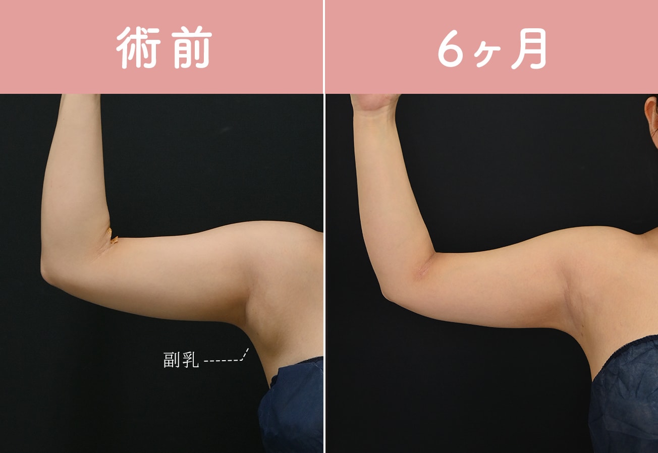 　　　　20代後半　150cm 52kg BMI23.1<br />
ベイザー脂肪吸引（二の腕全周+肩+肩甲骨上＋背中＋脇肉＋副乳）<br />
エンブレイス（二の腕）
