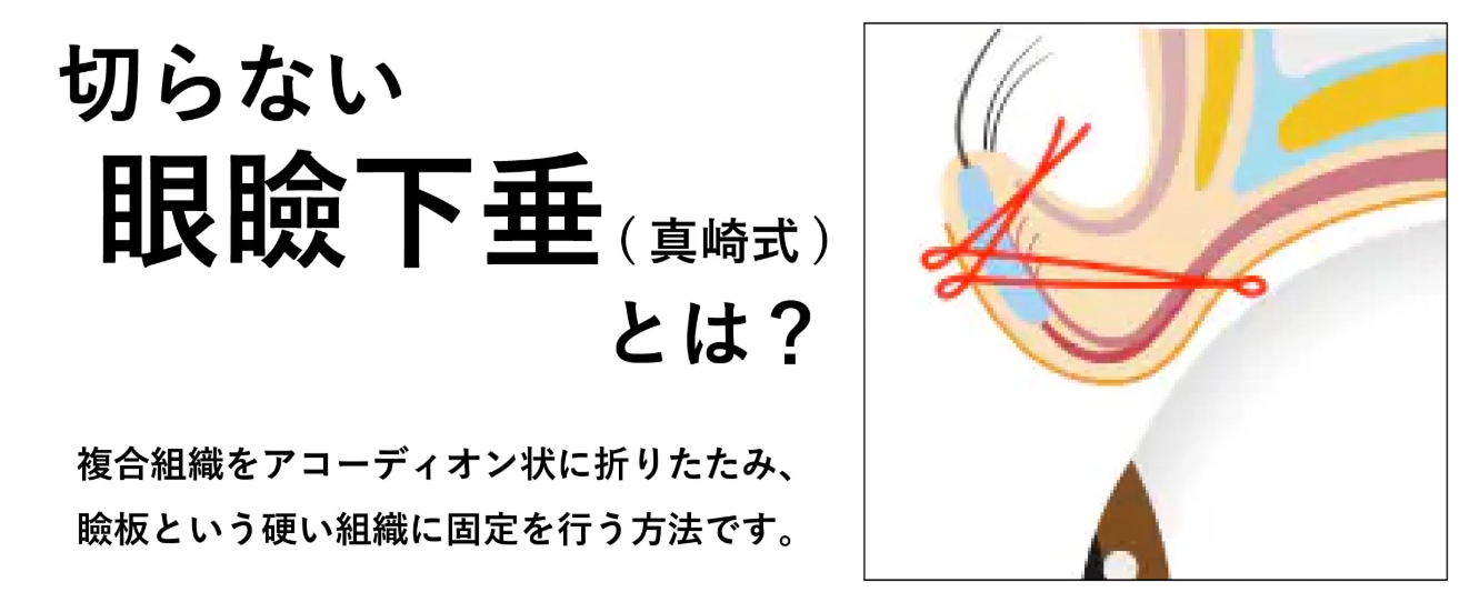切らずに瞼の開きを改善♻️