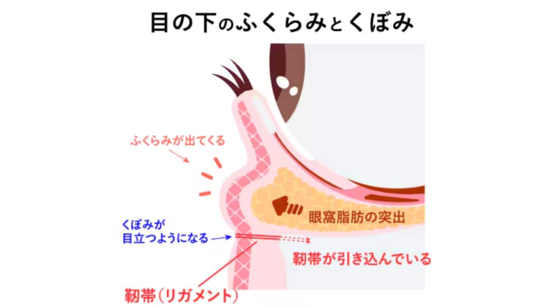 目の下のふくらみができる理由とは🤔
