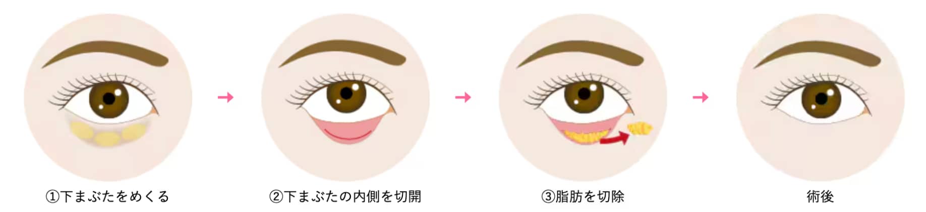 目の下の切らないクマ取り(脱脂術)