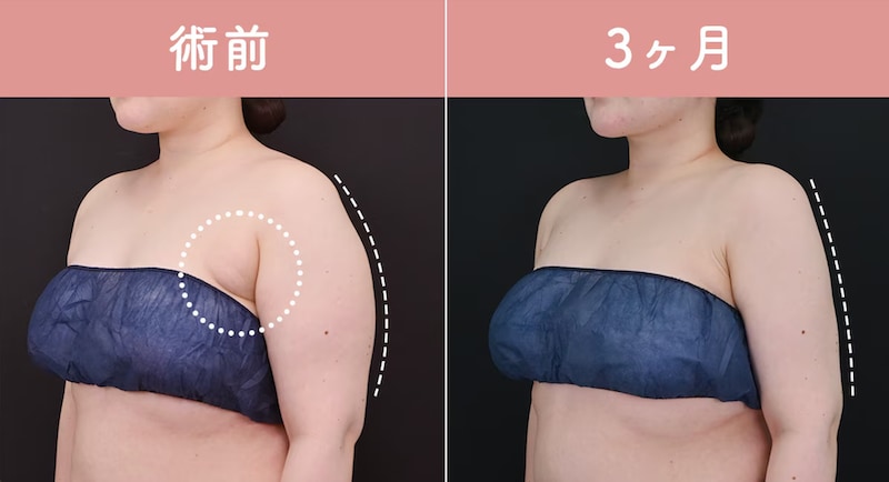 　　　　20代後半　160cm 75.9kg BMI29.6 <br />
アキーセル脂肪吸引（二の腕全周+肩+肩甲骨上＋背中＋脇肉＋副乳）