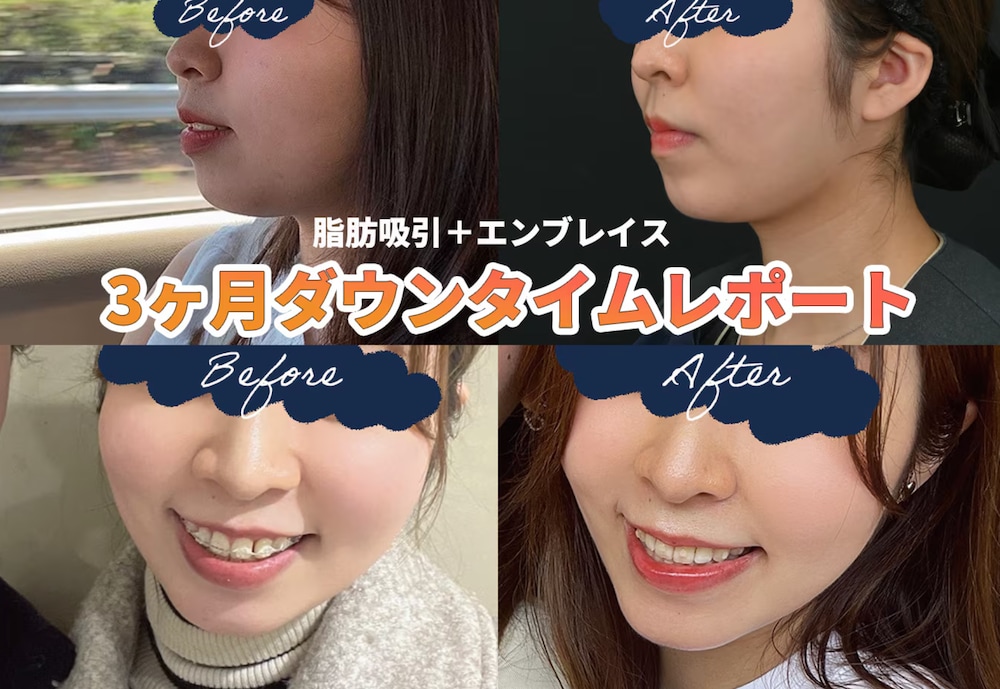 顔の脂肪吸引とエンブレイスのダウンタイムについて。脂肪吸引するなら“脂肪吸引の名医”山本高士先生にお任せ！　【湘南美容クリニック 名古屋栄院】