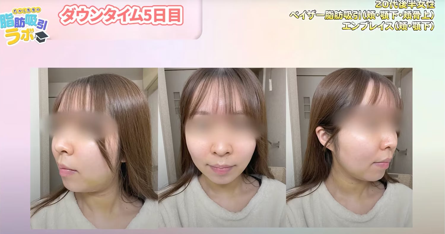 【ダウンタイム5日目】