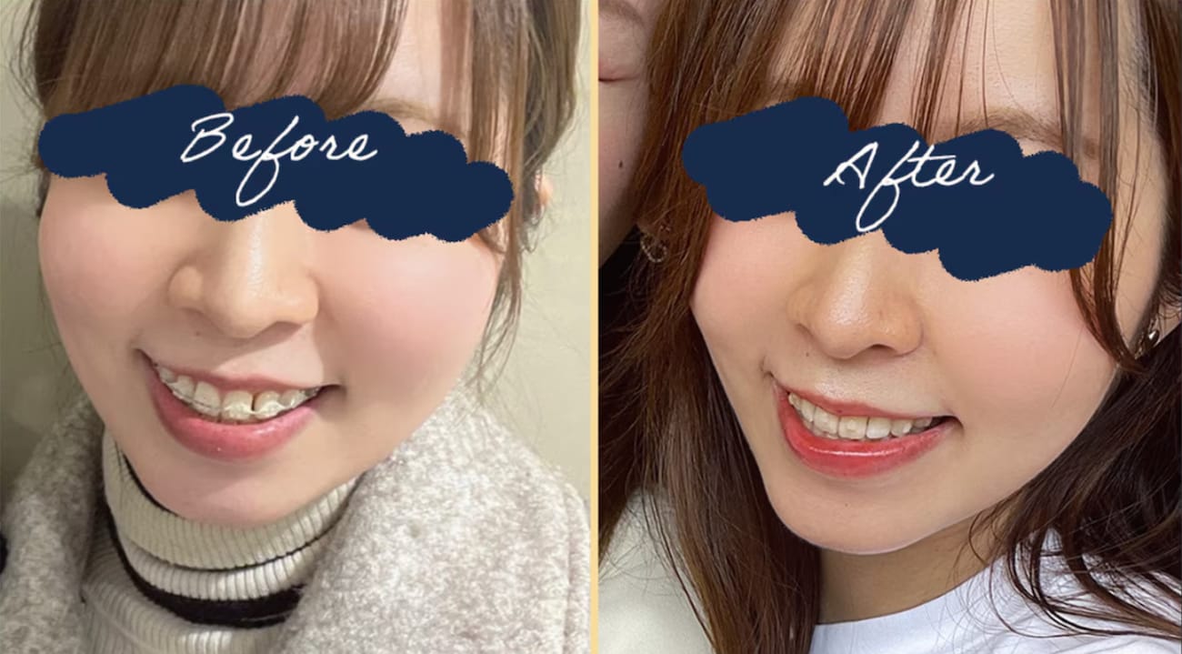 脂肪吸引とエンブレイスのダウンタイムレポートはいかがでしたか？