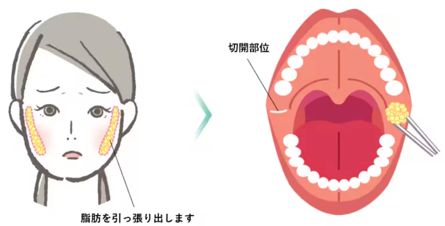 『口の中で吸える、噛んでしまう脂肪』『笑った時につまめる脂肪』