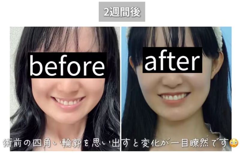 術後２週間