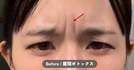 ボトックス注射のご予約