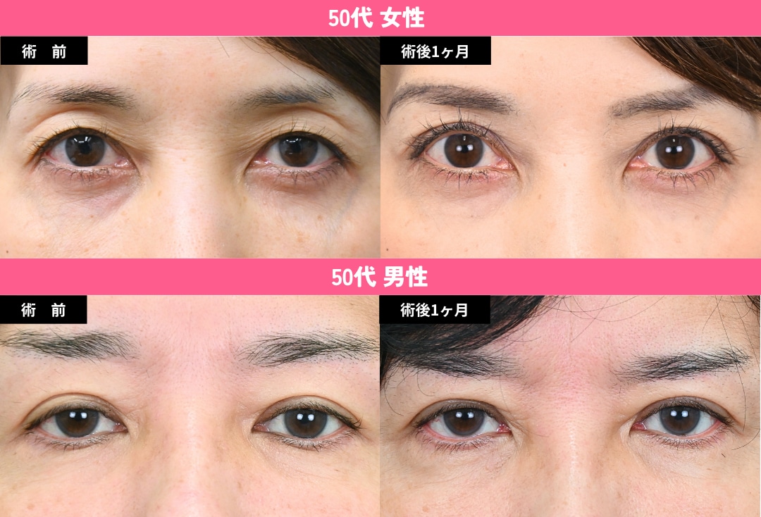 切らない眼瞼下垂(真崎式)🪡