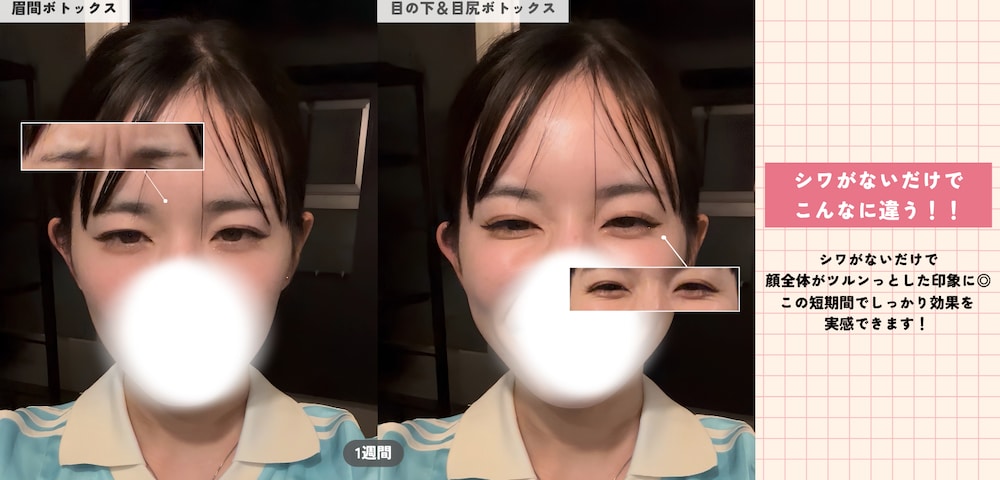 🗓1週間｜シワがないとこんなに違う‼️