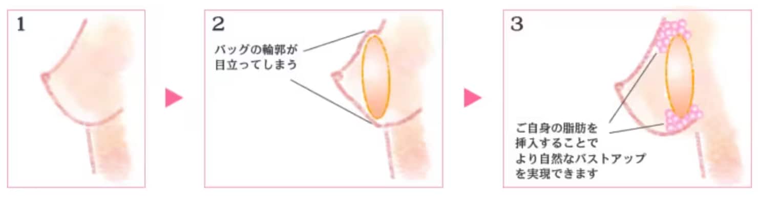 シリコンバッグ豊胸と脂肪注入豊胸の良いとこどり！