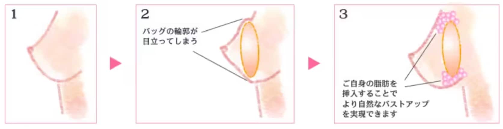 大きさも自然さも欲しい方へ！ハイブリッド豊胸