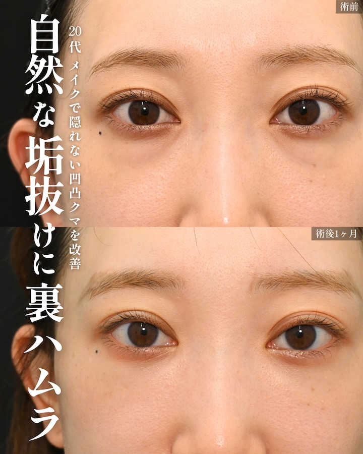 20代裏ハムラ法単体