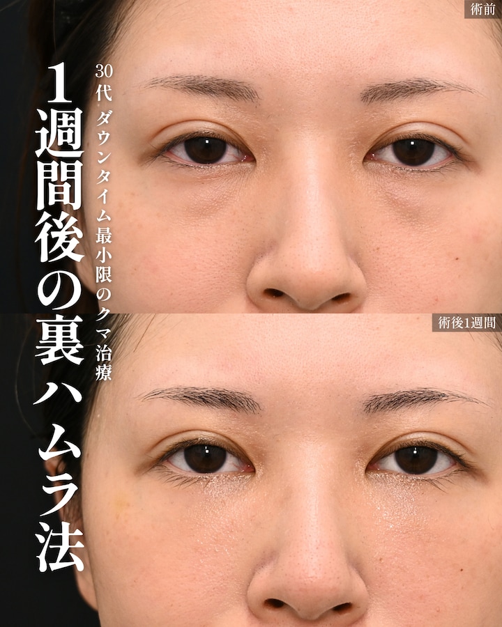 30代裏ハムラ法の1週間後