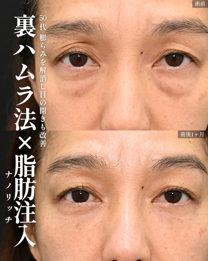 裏ハムラ法