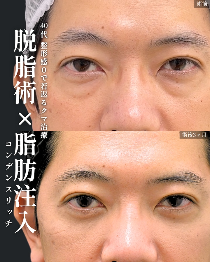 目の下の切らないクマ取り（脱脂法）