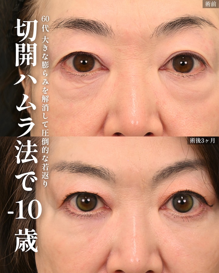 切開ハムラ法（表ハムラ法）