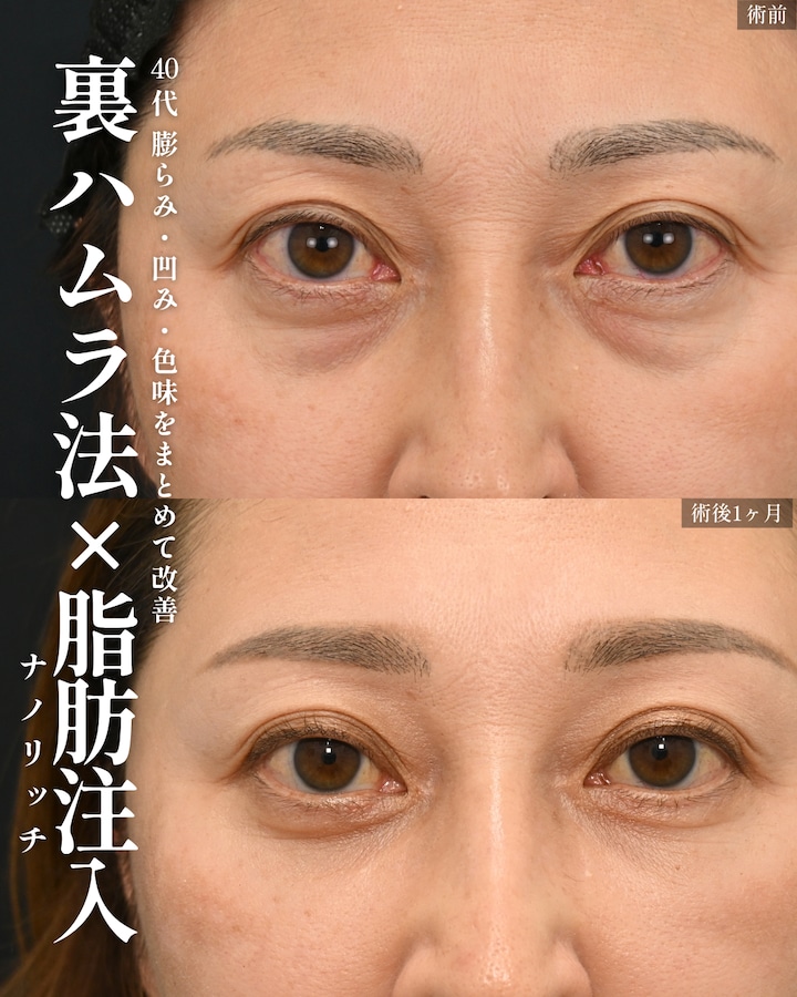40代裏ハムラ+脂肪注入(ナノリッチ)