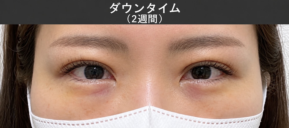 ほとんど気にならないレベルに