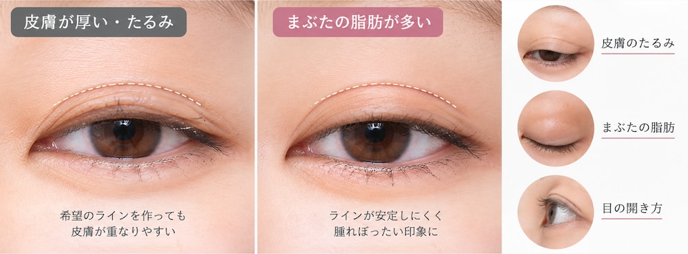 原因② まぶたの皮膚や脂肪の状態に合っていない