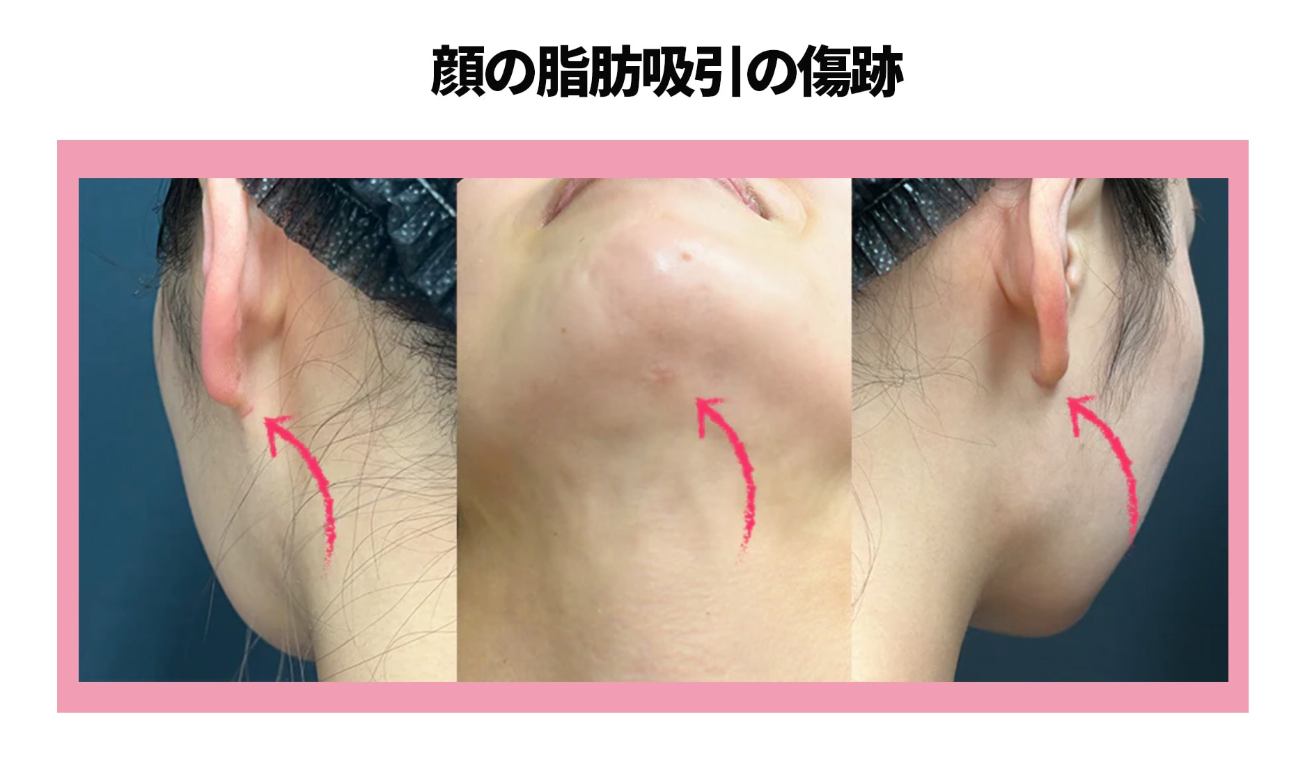 脂肪吸引傷跡（１ヶ月後の傷跡の写真）