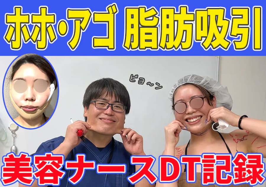 SBC名古屋栄院の美容看護師が顔の脂肪吸引をやってみた!【ダウンタイム記録】