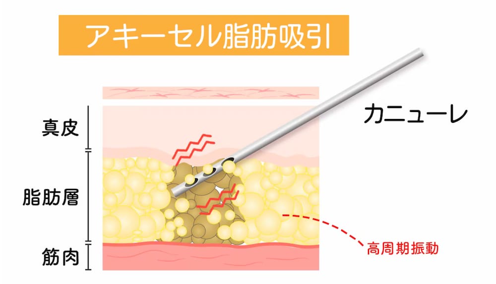 アキーセル脂肪吸引