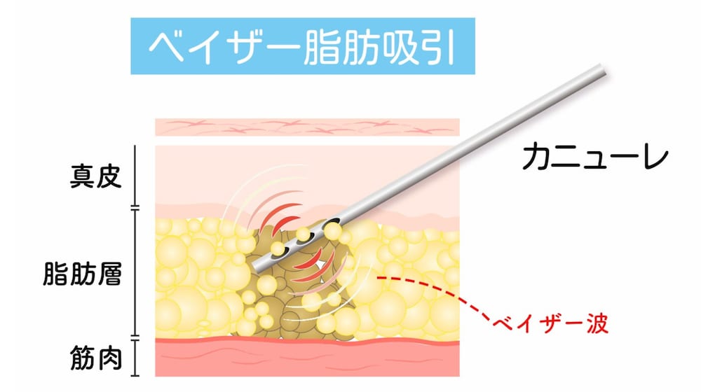 脂肪吸引の種類・比較の解説】アキーセルとベイザーではどっちの機械が
