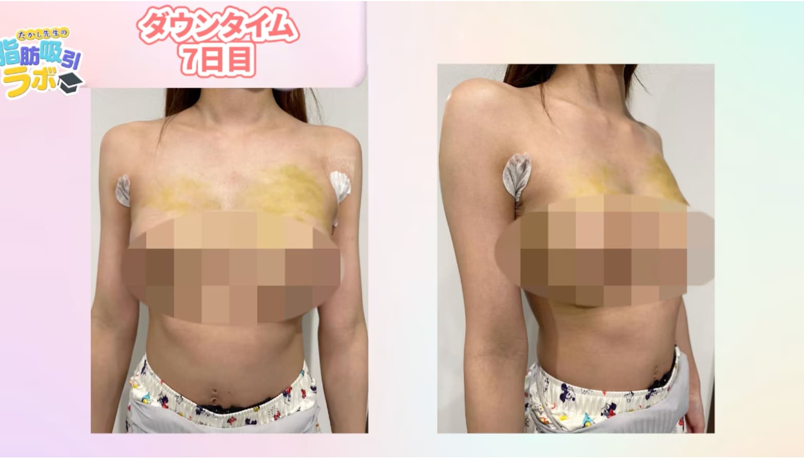 ダウンタイム7日目