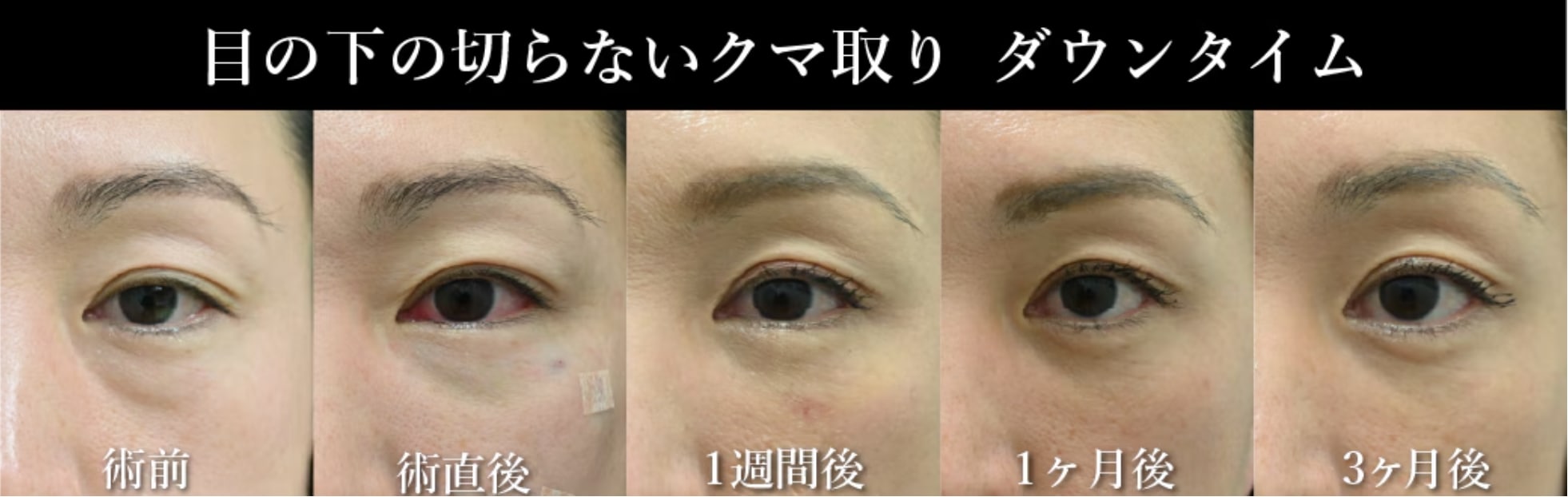 脱脂法