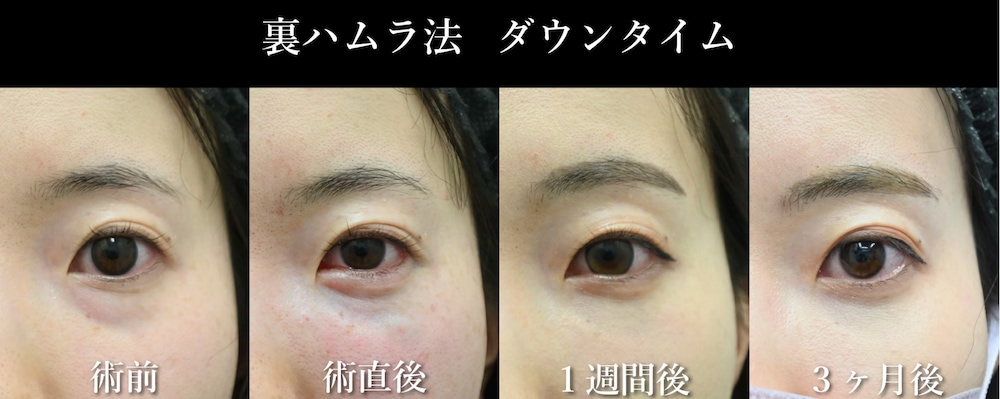 裏ハムラ