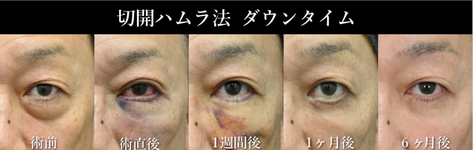 表ハムラ