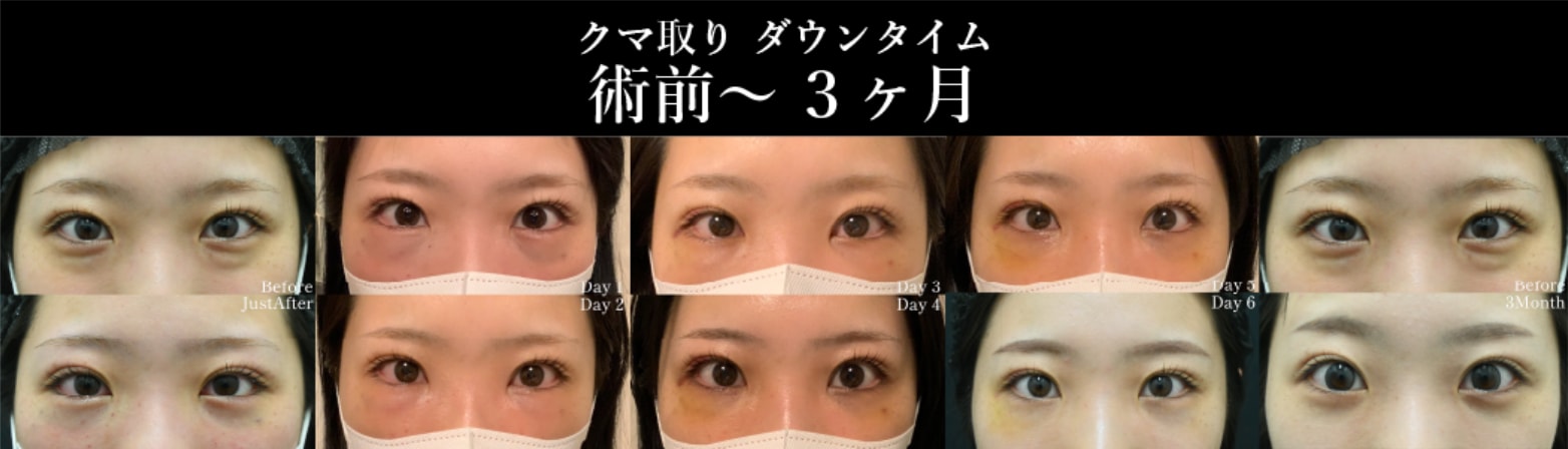 術前〜3ヶ月目