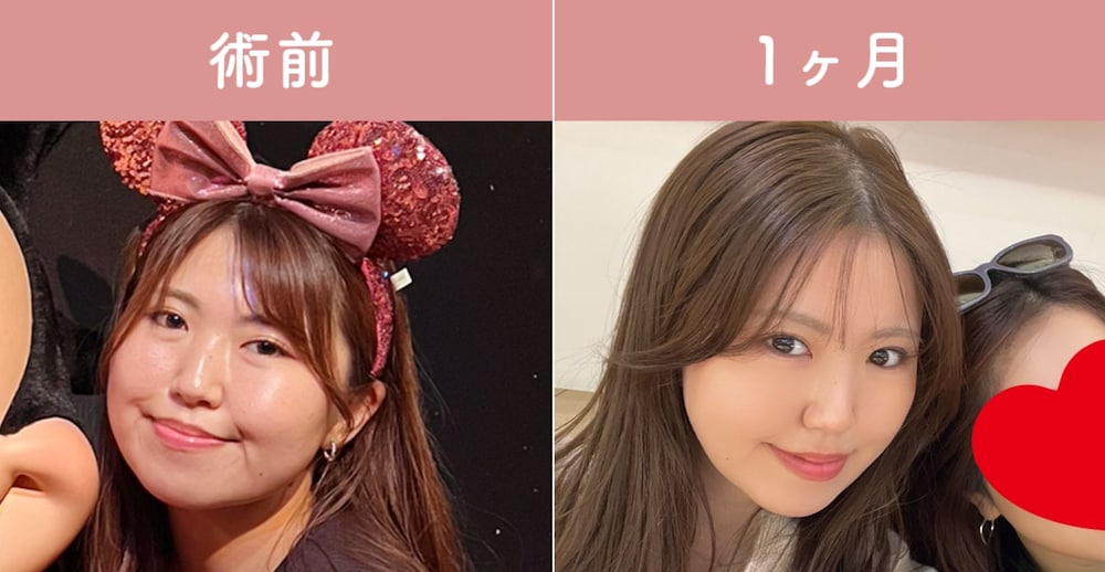 ①笑うと頬がアンパンマンのように膨らむ方