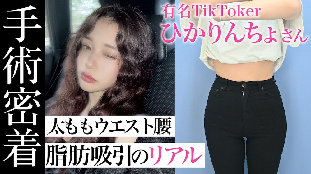 「長年の下半身太り」大量の脂肪に感動!ひかりんちょさんの脂肪吸引に密着【湘南美容クリニック名古屋院 山本高士医師】
